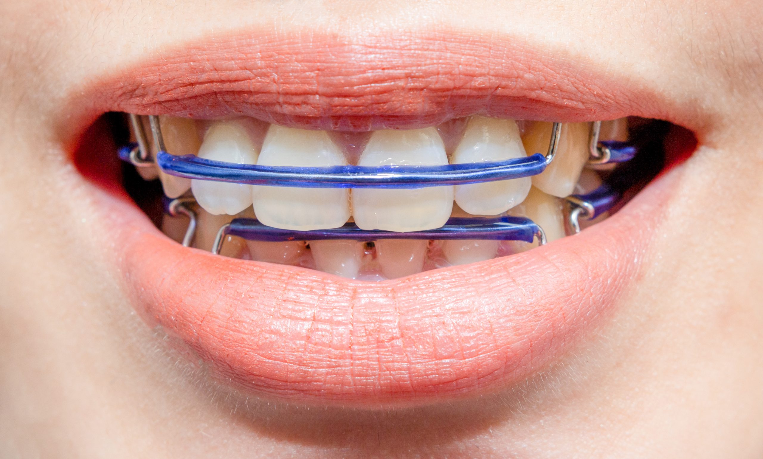 ไขปัญหาโลกแตก! รีเทนเนอร์ ต้องใส่นานแค่ไหน - Dental Life Clinic ไขปัญหาโลกแตก! รีเทนเนอร์ ต้องใส่นานแค่ไหน - Dental Life Clinic