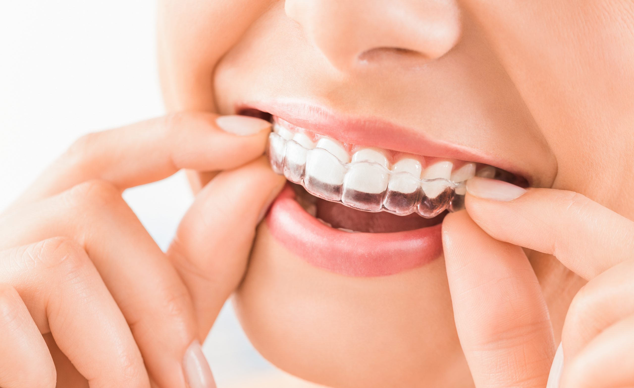 จัดฟันใส Invisalign