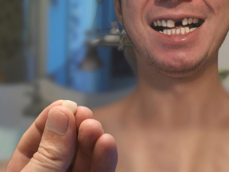 หากคุณฟันหายไป 1 ซี่ ผลกระทบที่ตามมาคืออะไรบ้าง Dental life มีคำตอบ