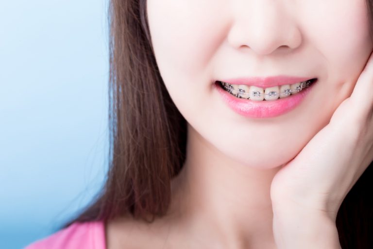 เทคนิคควรรู้! ดูแลฟันสวยระหว่างจัดฟัน